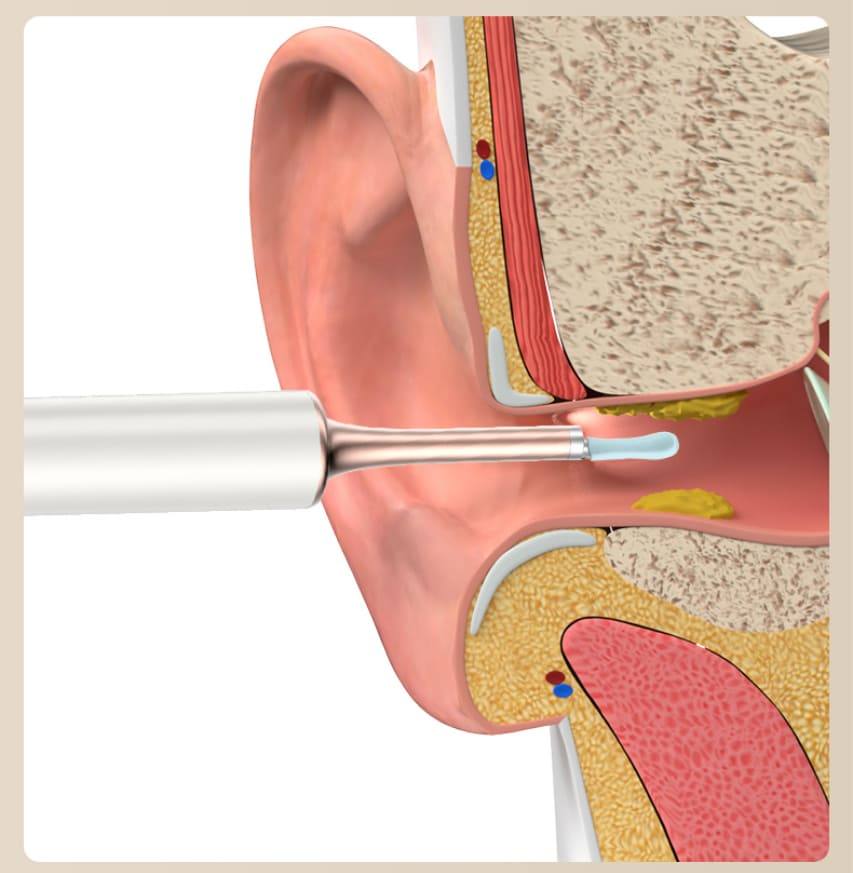 kõrvavaha eemaldaja kõrva puhastamiseks